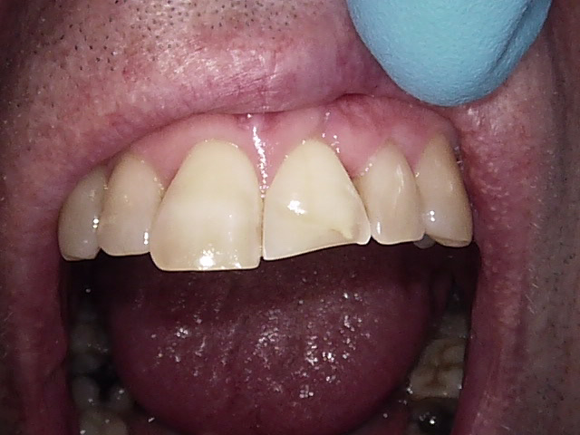 Composite veneers before, Wellington patient at Thorndon Dental