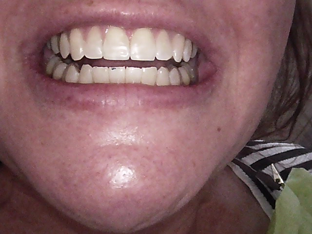Composite veneers after, Wellington patient at Thorndon Dental