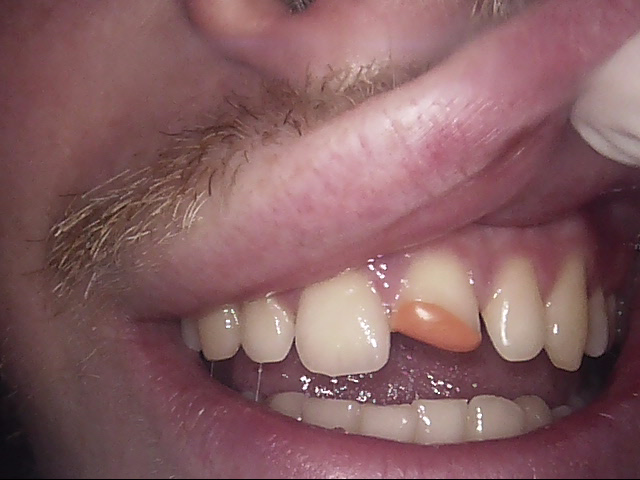 Composite veneers before, Wellington patient at Thorndon Dental