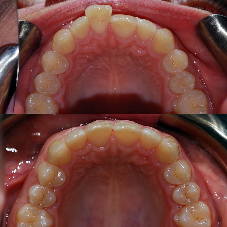 Before and after clear aligner treatment on a Thorndon Dental patient