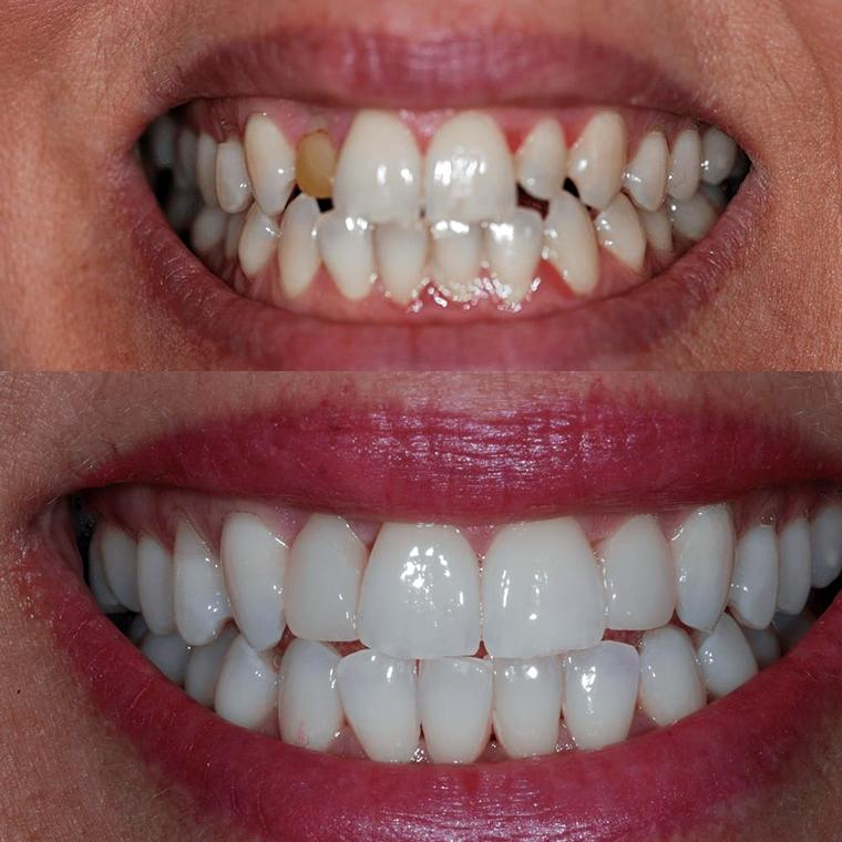 Before and after professional teeth whitening on a Thorndon Dental patient
