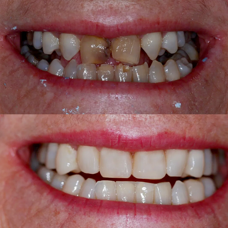 Before and after porcelain veneers on a Thorndon Dental patient: worn, discoloured upper teeth above, an even white smile below